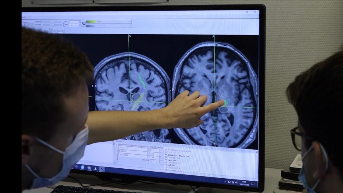 El Hospital público Clínico San Carlos de la Comunidad de Madrid reduce un 80% el temblor esencial y asociado a la enfermedad de Parkinson