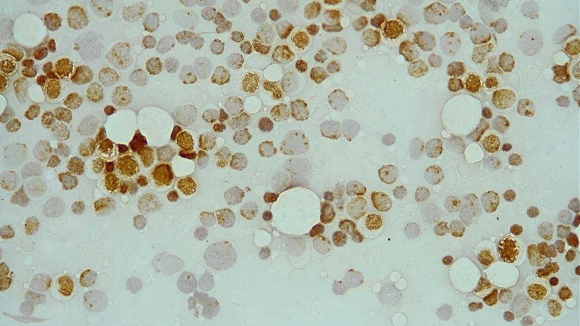 Las alteraciones de unas proteínas detectarían casos de leucemia mieloide aguda que no responden a la terapia estándar